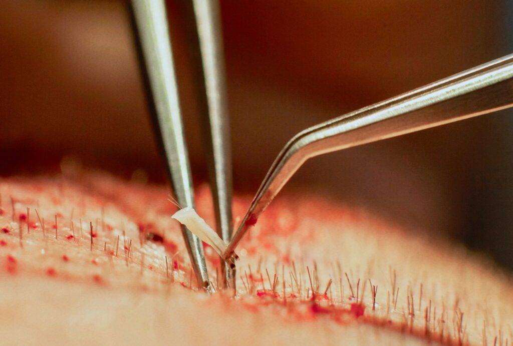 Close-up of surgical tweezers removing a suture from human skin during a hair implant procedure, showcasing the meticulous detail of a stitch removal.