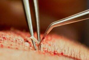 Close-up of surgical tweezers removing a suture from human skin during a hair implant procedure, showcasing the meticulous detail of a stitch removal.