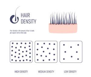 Illustration explaining hair density and female hair loss with an image of hair strands in skin and three diagrams showing high, medium, and low density of dots representing hair strands per area.