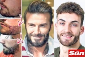 Collage of three men showcasing different beard styles. From left: a close-up of a neatly trimmed beard, a man with hair implant and groomed beard smiling, and a young man with a full