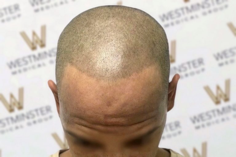 Close-up photo of a person's head showing the top of their balding scalp with visible male pattern baldness. The background features a repeated "Westminster" logo pattern.