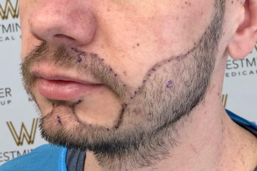 Close-up of a man's lower face showing beard area with skin marked by purple lines and dots, likely for a medical or cosmetic hair surgery procedure.