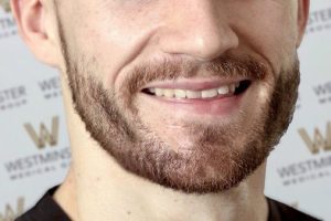 Close-up of a smiling man with a light brown beard after a hair implant, focusing on his mouth and chin against a blurred background with text.