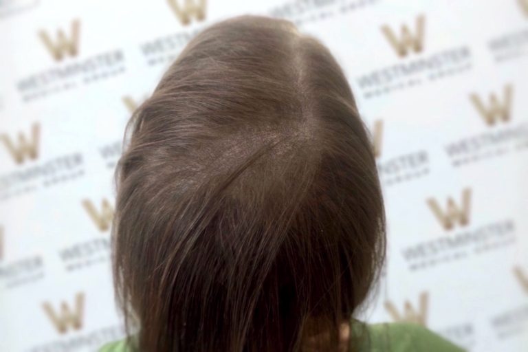 Top view of a person's head showing brown hair with visible thinning on the scalp, indicative of female hair loss. A patterned background with the letter "w" repeated is visible.