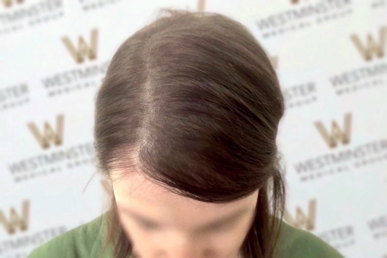 Close-up of a person's head showing their hair parted in the center with slight thinning visible, indicating female hair loss, set against a background with blurred logos.
