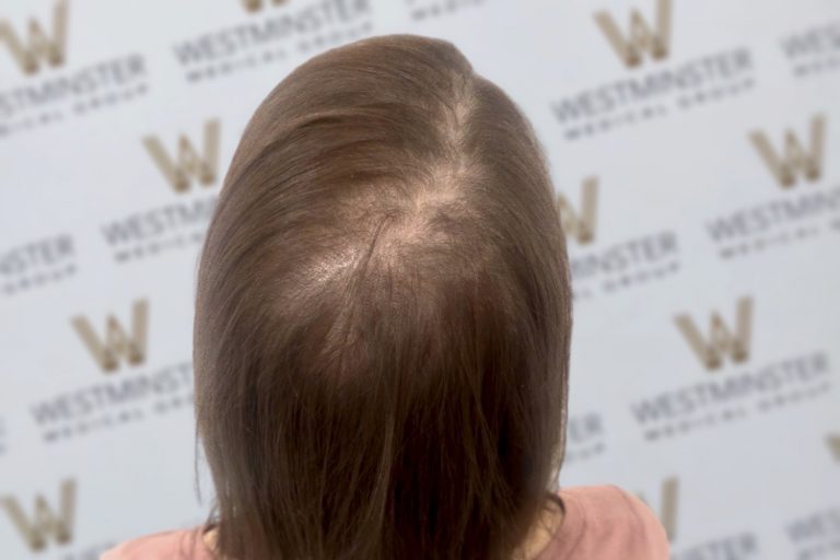 Back view of a person's head showing the top of their scalp with thinning hair, indicative of male pattern baldness, against a background with multiple logos reading "westminster.