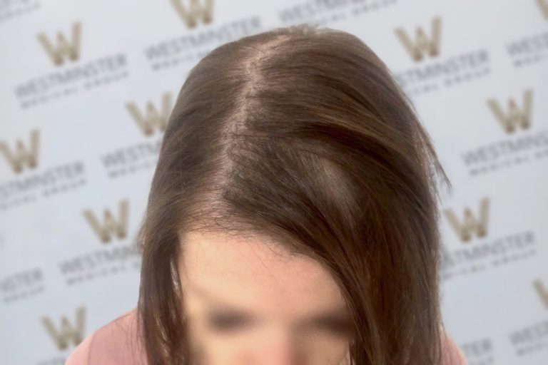 Top view of a person’s head with brown hair, showing male pattern baldness. In the background, a blurred banner with "Westminster" visible. The face is intentionally blurred and not visible.