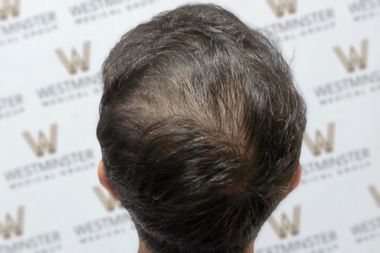Close-up of the top of a person's head showing thick, dark hair styled to one side against a background with a repetitive 'westminster' logo, ideal for showcasing solutions for female hair loss.
