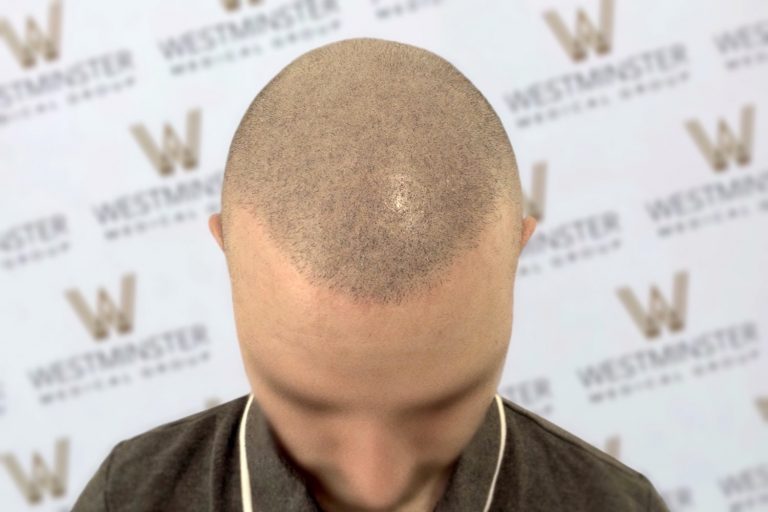 Top view of a balding man's head showing male pattern baldness, with a patterned background marked with the "Westminster" logo.