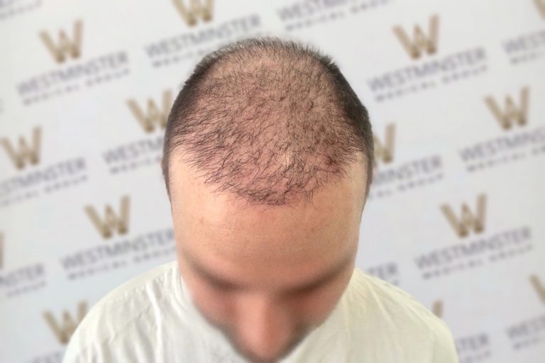Top view of a man's head showing early stages of male pattern baldness with thinning hair on the crown, against a background with a repeated logo pattern.