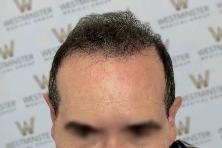 Close-up of a man's forehead and hairline with visible male pattern baldness, set against a backdrop with a repeated logo pattern. His eyes and other facial features are out of frame.