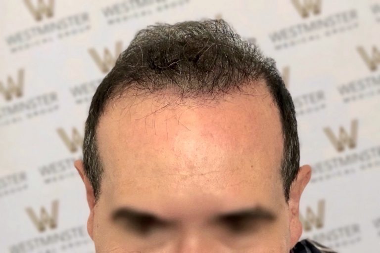 Close-up photo of a man with a receding hairline, focusing on the forehead and hair replacement. Background blurred, with visible "Westminster" logos.
