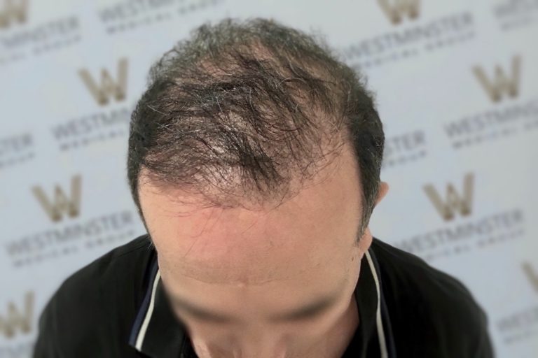 Top view of a man's head showing male pattern baldness and a receding hairline, against a backdrop with "Westminster" logos repeated.