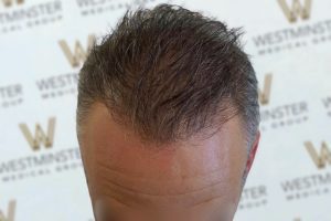 Close-up photo of a person's head showing the top of their forehead and hair replacement, with a backdrop featuring multiple logos reading "westminster." the hair is dark and slightly wet or styled.