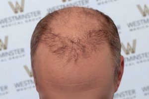 Top view of a man's head showing significant male pattern baldness on the scalp with a background of a banner featuring repeated "westminster" logos.