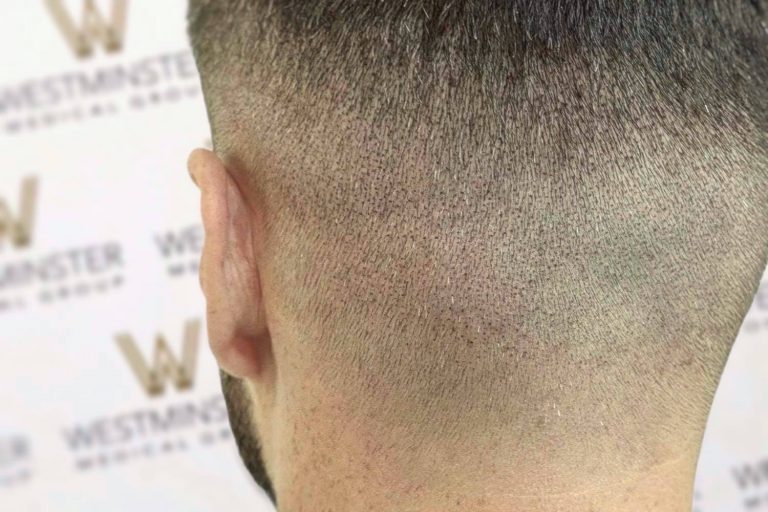 Close-up of a person's freshly buzzed haircut, showing the back of their head with a natural hair pattern and slight stubble from recent hair implant surgery on the scalp.