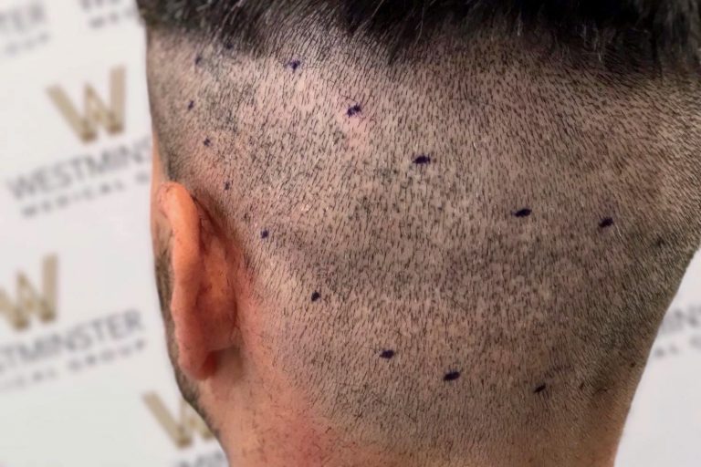 Close-up of a person's head from the side, showing a freshly shaved area with numerous small, dark blue dots tattooed on the scalp, typical of hair replacement treatment.
