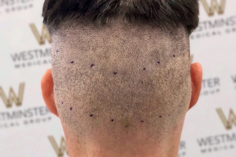 Back view of a person's head showing a closely shaved scalp with small, evenly spaced blue dots marked for a hair implant procedure, set against a backdrop with "Westminster Medical" logos.