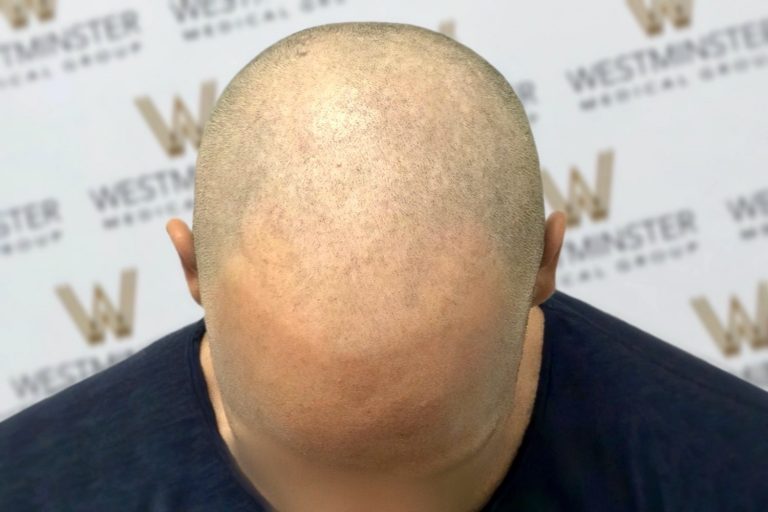 Close-up photo of a bald man’s head shot from above, post hair replacement surgery, showing the top of his scalp against a background with the repeated logo "Westminster.