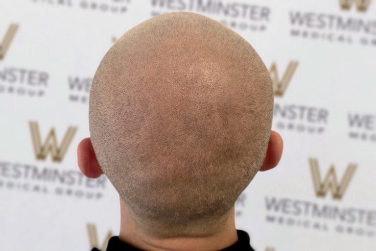 Rear view of a bald person's head showing very faint hair growth, indicating early signs of male pattern baldness, in front of a background with the repeated logo of "Westminster Medical Group.
