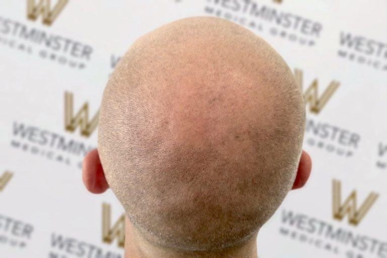 Close-up of the back of a head with male pattern baldness in front of a backdrop with multiple "Westminster" logos printed in a diagonal pattern.