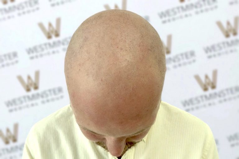 Top view of a bald man's head with a slightly visible hairline, looking downward against a background patterned with "westminster" logos, showing signs of hair regrowth.