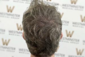 Back view of a person's head showing signs of male pattern baldness with dark hair against a backdrop with a repeated "westminster" logo.