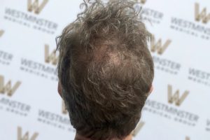 Back of a man's head showing gray curly hair with a balding spot post-hair replacement, against a background with "westminster" logos repeated in a pattern.