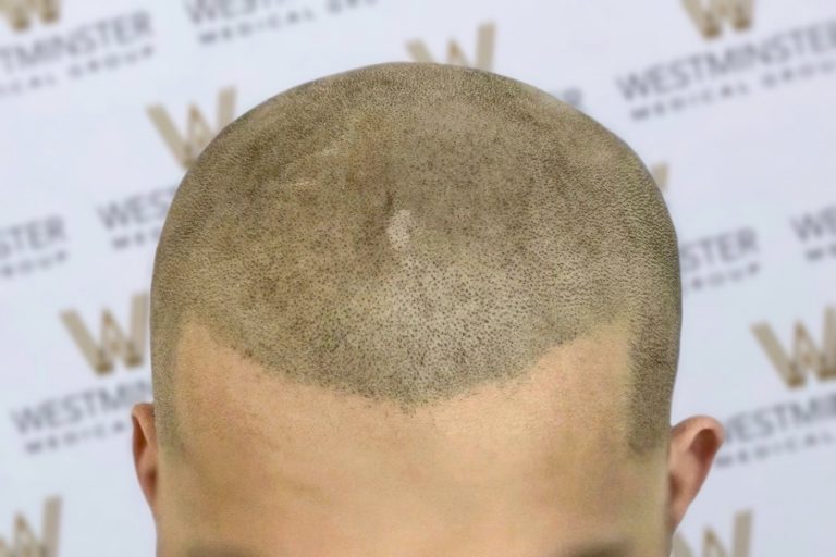 Close-up photo of a person's head from the back, showing a buzz cut with visible signs of male pattern baldness and slight scalp discoloration against a branded backdrop.