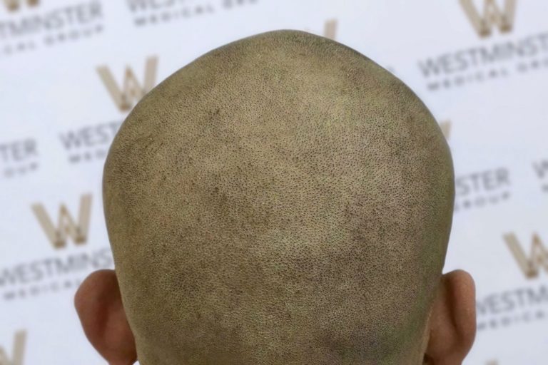 Close-up view of a person holding a cantaloupe with the stem end facing the camera, set against a backdrop with the Westminster logo repeated. The focus is on the textured surface of the fruit