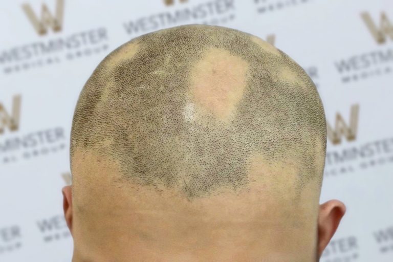 Close-up of the back of a bald head with a light patch of hair resembling an exclamation mark, possibly due to recent hair implant, against a blurred background with logos.