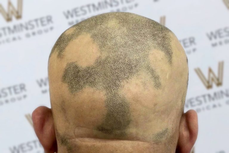A man's head viewed from behind with a detailed map of the world hair-implanted on his scalp against a backdrop with "Westminster" logos.
