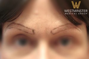 Close-up view of a person's eyebrows with visible pencil markings for a possible hair implant procedure. The image is slightly blurred and includes the logo of Westminster Medical Group in the corner.