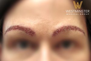 Close-up of a person’s eyes and eyebrows, with fresh microblading marks on the eyebrows. The Westminster Medical Group logo, specializing in female hair loss, is visible at the bottom.
