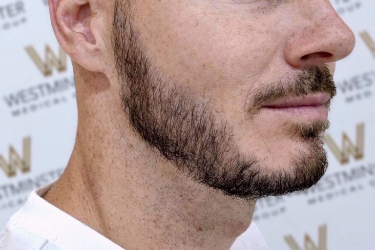 Close-up of a man's lower face showing his jawline, beard, and part of his mouth with a white shirt collar visible, against a background with a blurred text logo about hair implant.