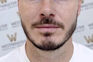 Close-up of a man's lower face showing his nose, mouth, and beard affected by male pattern baldness. The background features a pattern with the text "Westminster." The beard is neatly trimmed