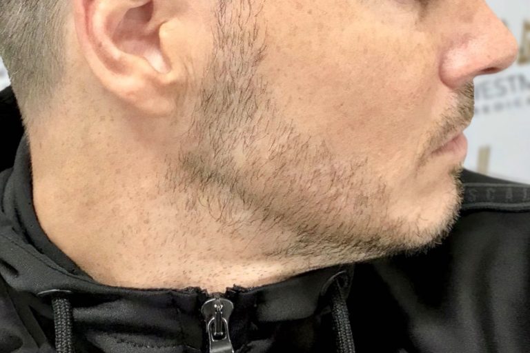 Close-up of a man's lower face and neck showing stubble, focusing on his jawline. He's wearing a black jacket with a zipper, indicative of his recovery post-hair regrowth surgery