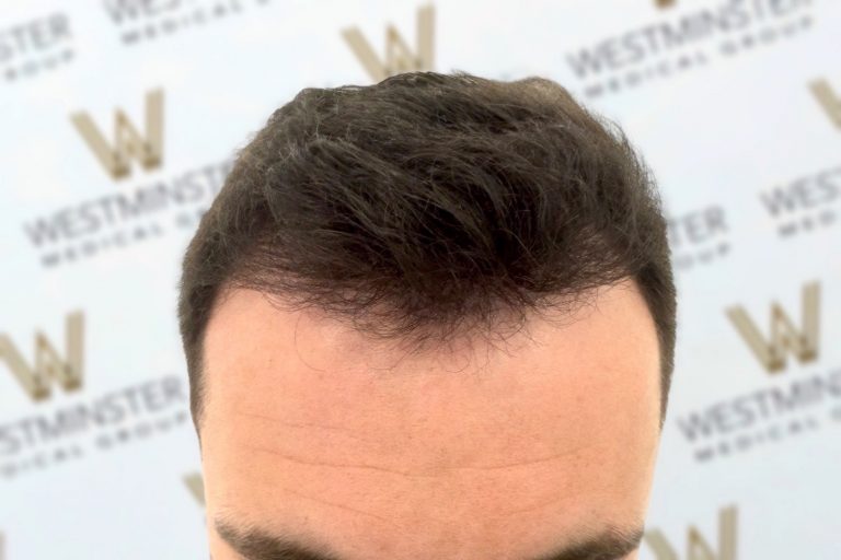 Close-up of a man's head from the forehead up showing thick, black hair with slight graying at the roots after a recent hair replacement, against a background with a repeating "westminster" logo