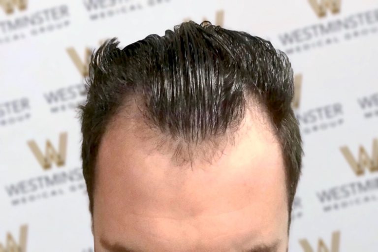 Close-up of a person's forehead and hairstyle, showing dark hair styled upwards with visible thinning at the hairline indicative of male pattern baldness. The background features a blurred logo with text "west