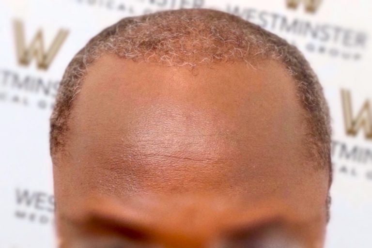 Close-up top view of a person's head showing signs of hair thinning and pattern baldness, ideal for discussing hair replacement options, set against a backdrop with logo watermarks.