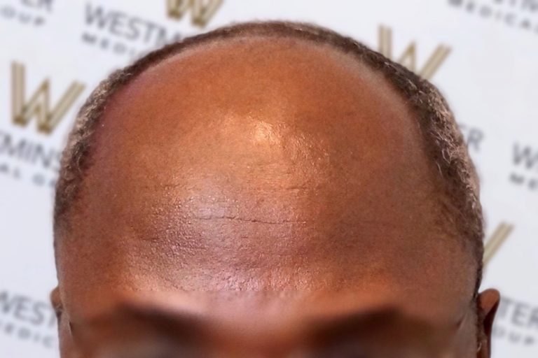 Close-up photo of the top of a man's head, showing his hairline and bald scalp with a branded backdrop behind, ideal for hair replacement ads.