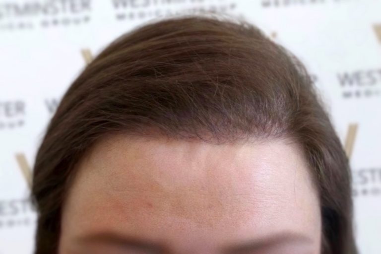 Close-up image of a person's forehead showing male pattern baldness with thinning brown hair, against a background with the repeated logo "westchester medicine".