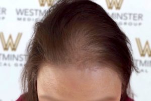 Close-up image of a person's forehead showing visible hair thinning with a background pattern of logos for Westminster Medical Group specializing in hair regrowth.