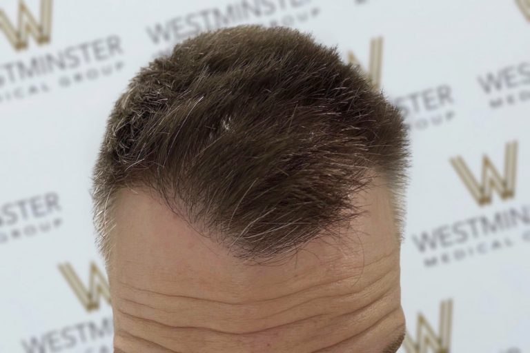 Close-up of a person's forehead and hairline, with male pattern baldness visible, against a background featuring a repeating 'westminster' logo pattern.