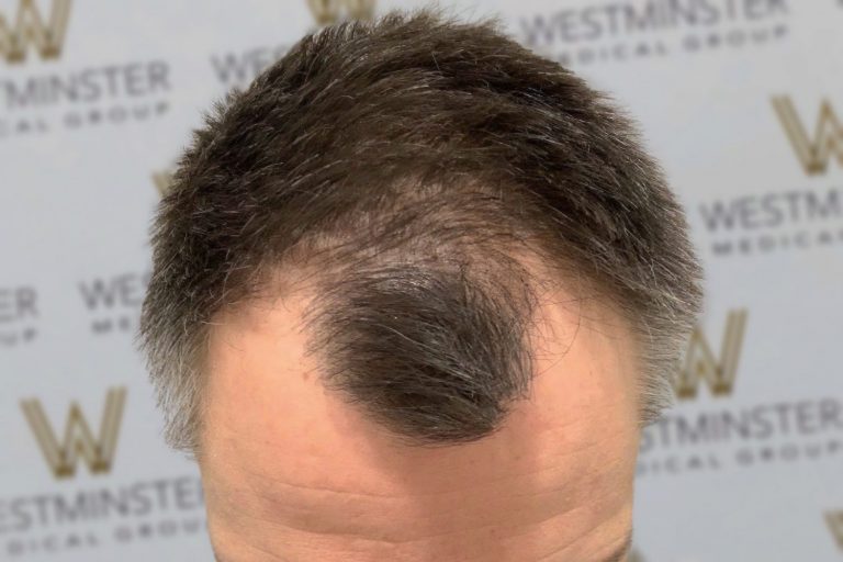 Close-up of a person's head focusing on the top and showing the hair, with a background featuring a repeated logo of "Westminster Medical Group." The hair looks thick with an area showing male pattern