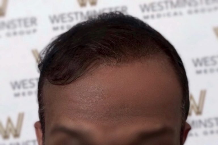 Top half of a person's face showing hairline and eyebrows after hair replacement surgery, with a blurred background displaying the "Westminster" logo.