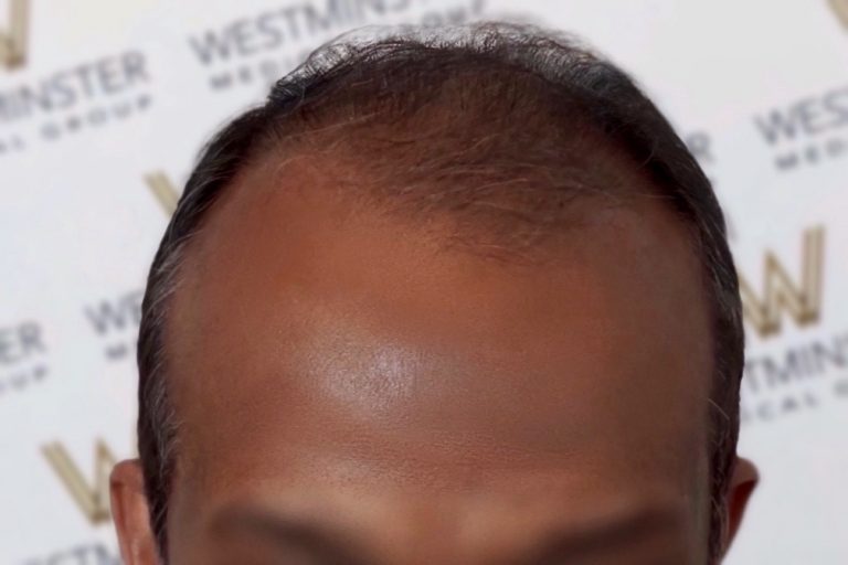 Close-up image of a man's forehead showing early signs of hair loss with a receding hairline. The background is a blurred wall with logos.