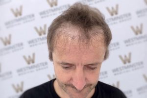 Close-up of a man's head showing male pattern baldness, focusing on the top and forehead, against a background with a repeated logo pattern.