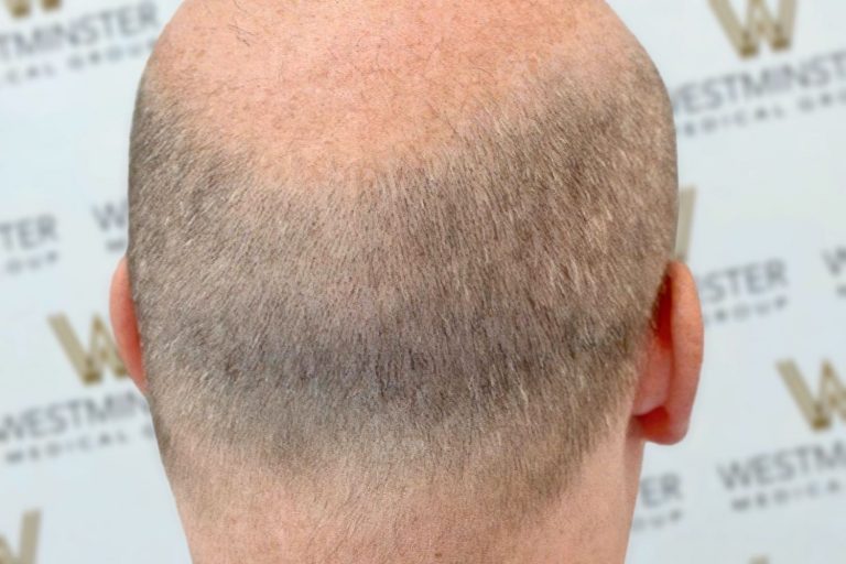 Close-up view of a male's head from behind, showcasing early stages of male pattern baldness with thinning hair and visible scalp, against a background featuring a repeated logo pattern.