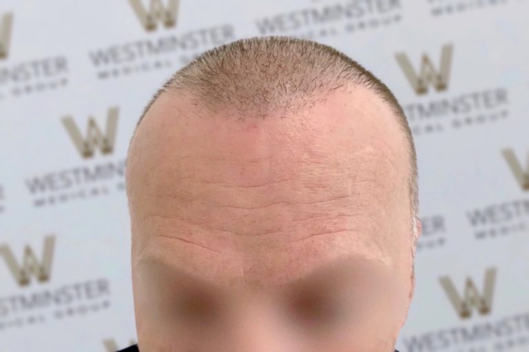 Close-up of the top part of a person's face showing the forehead and hair regrowth. The background features a repeated logo with the word "Westminster." The eyes are blurred for privacy.